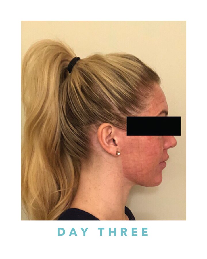 Biogel recovery, day three