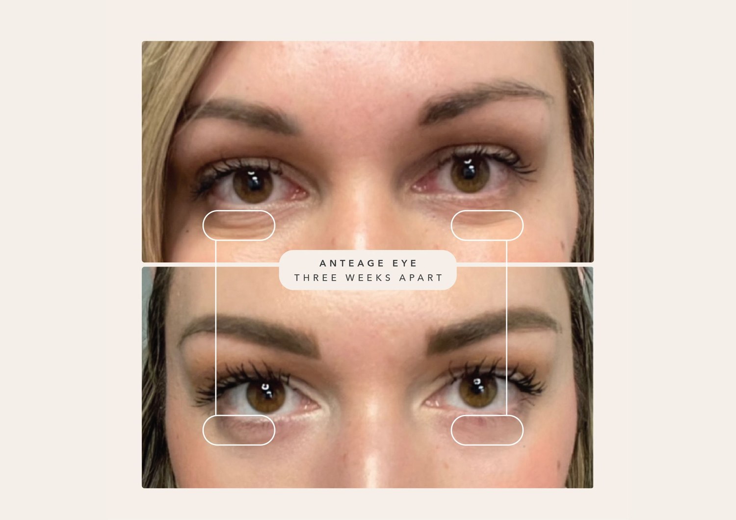 AnteAGE Eye before and after, three weeks apart
