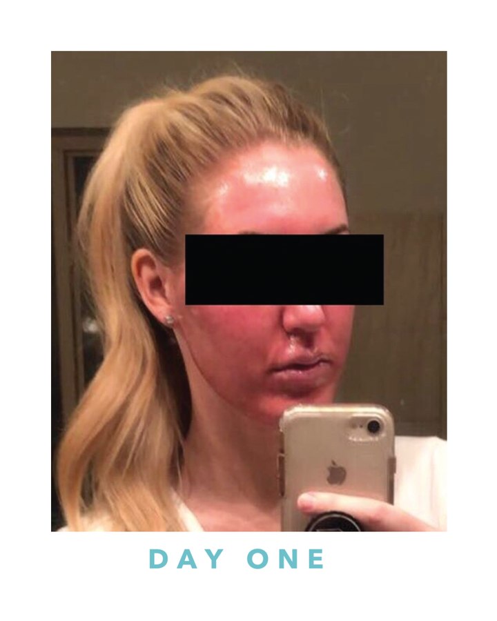 Biogel recovery, day one