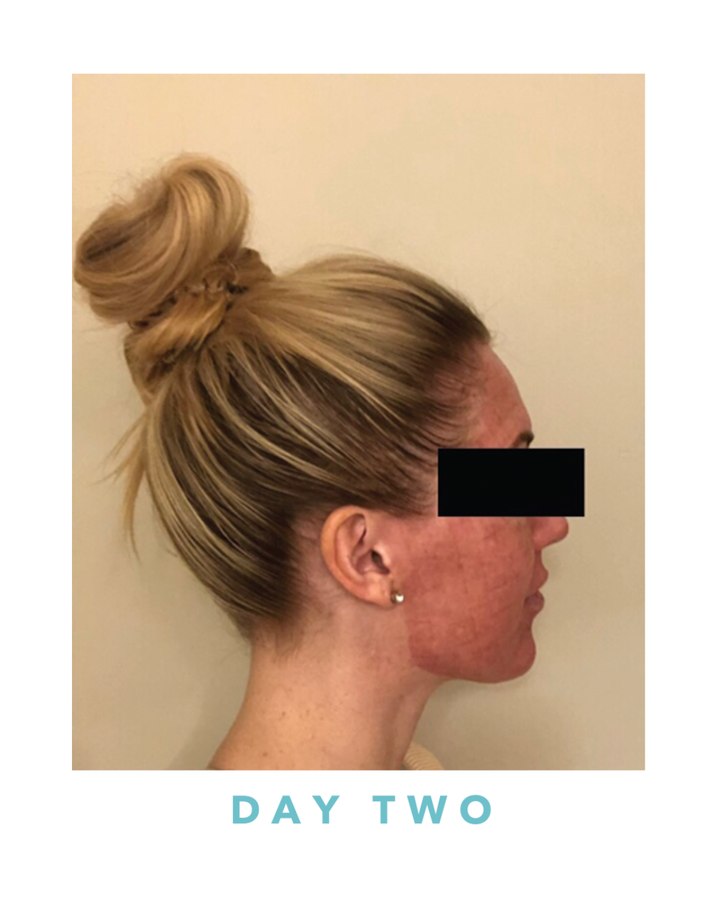 Biogel recovery, day two