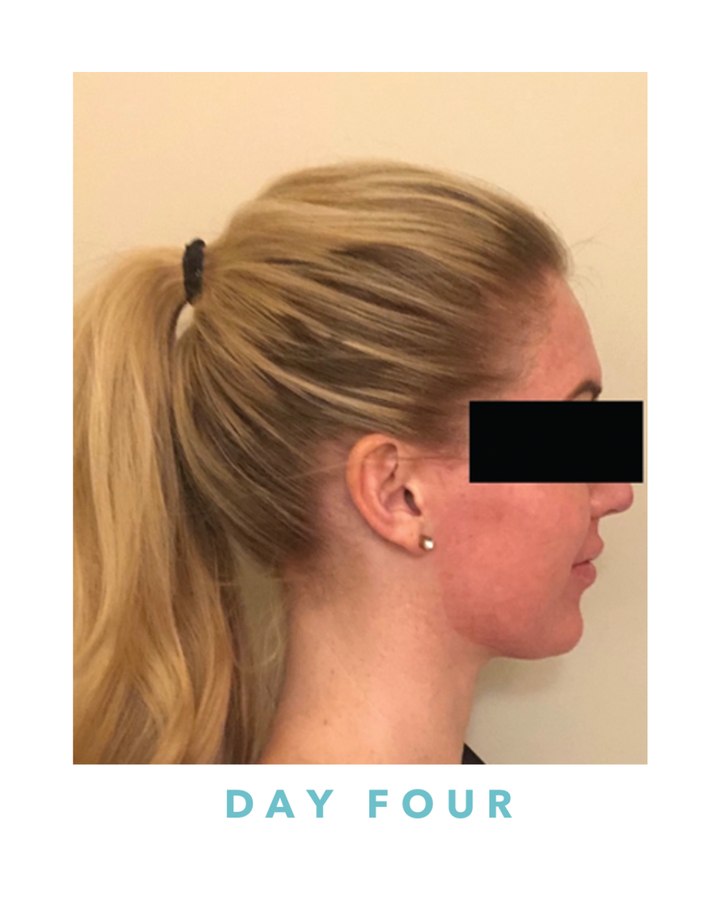 Biogel recovery, day four