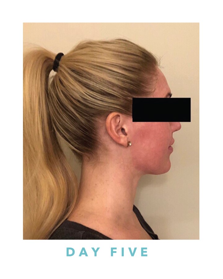 Biogel recovery, day five