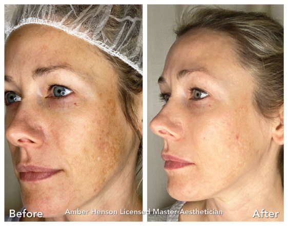 Before and after: four microneedling treatments plus daily Brightener