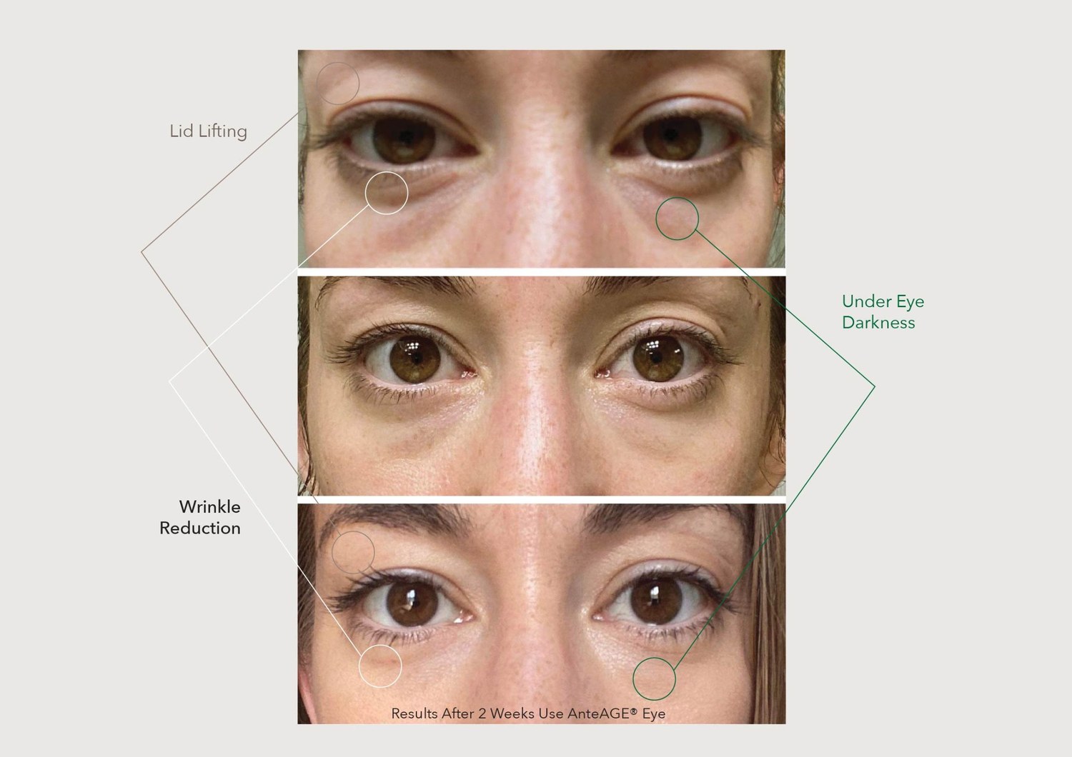 Lid lifting, under eye darkness and wrinkle reduction
