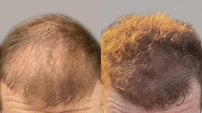 Before and after: One microneedling session, plus the Home Hair System at home. One month.