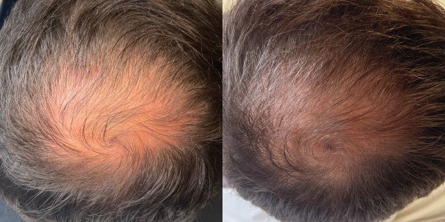 Before and after: Two microneedling sessions, plus the Home Hair System at home. Two months.