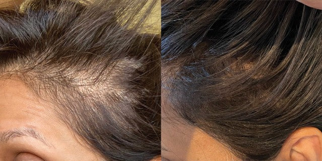 Before and after: Five microneedling sessions, plus the Home Hair System at home. Two and a half months.