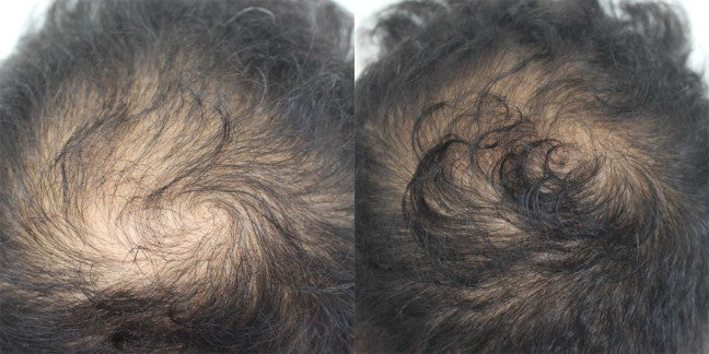 Before and after: Seven microneedling sessions, plus the Home Hair System at home. Three and a half months.