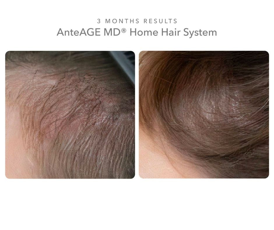 Three months results with the AnteAGE MD Home Hair System