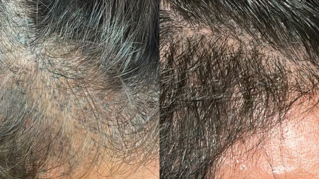 Before and after in-office hair microneedling with AnteAGE MD Hair Solution