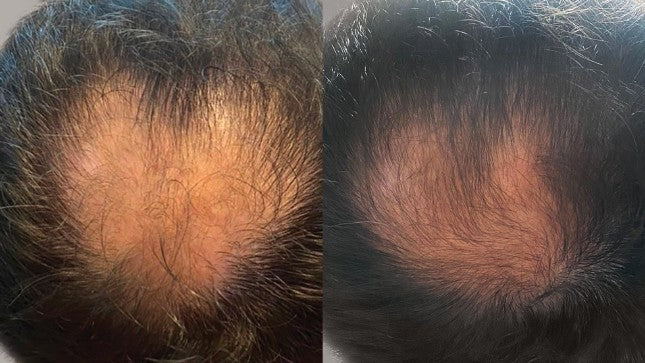 Before and after in-office hair microneedling with AnteAGE MD Hair Solution