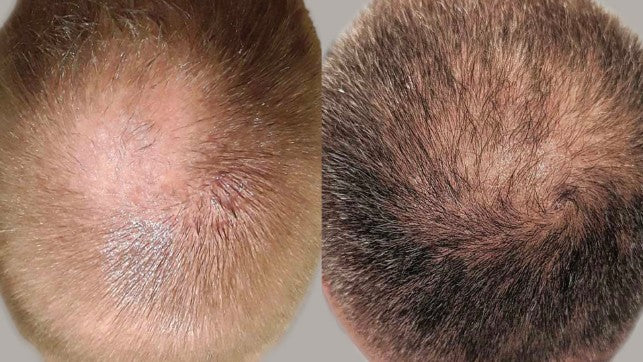 Before and after in-office hair microneedling with AnteAGE MD Hair Solution