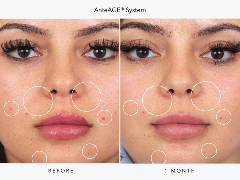 AnteAGE System before and after one month