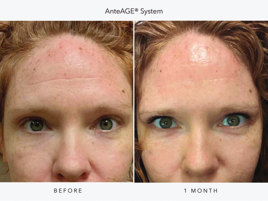 AnteAGE System before and after one month