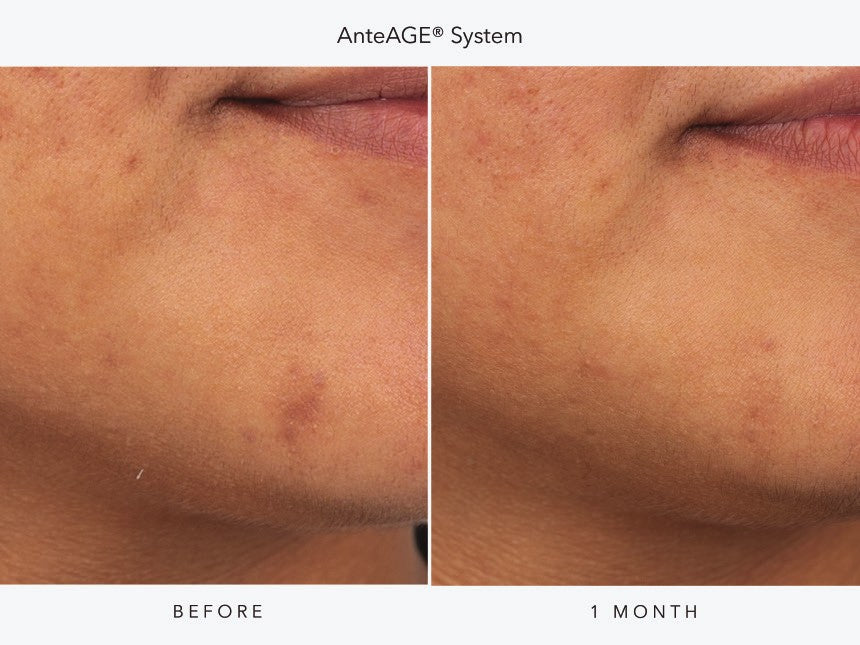 AnteAGE System before and after one month